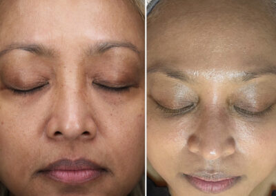 East Shore Med Spa The Woodlands TX Halo before and after