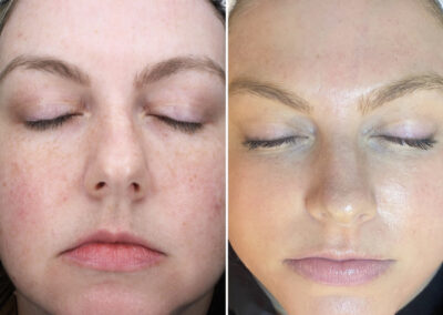 East Shore Med Spa The Woodlands TX Halo before and after